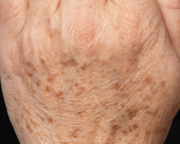 Before Wrinkle & Spot Removal